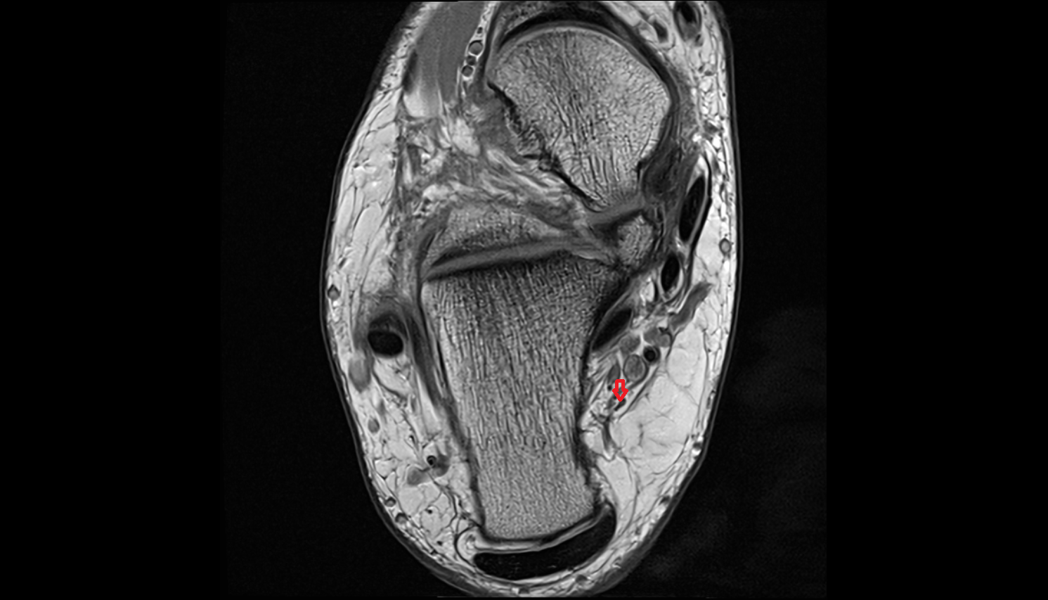 Medial calcaneal nerve  axial cross sectional anatomy 3T MRI AI enhanced radiology image-img-00000-00000_00001