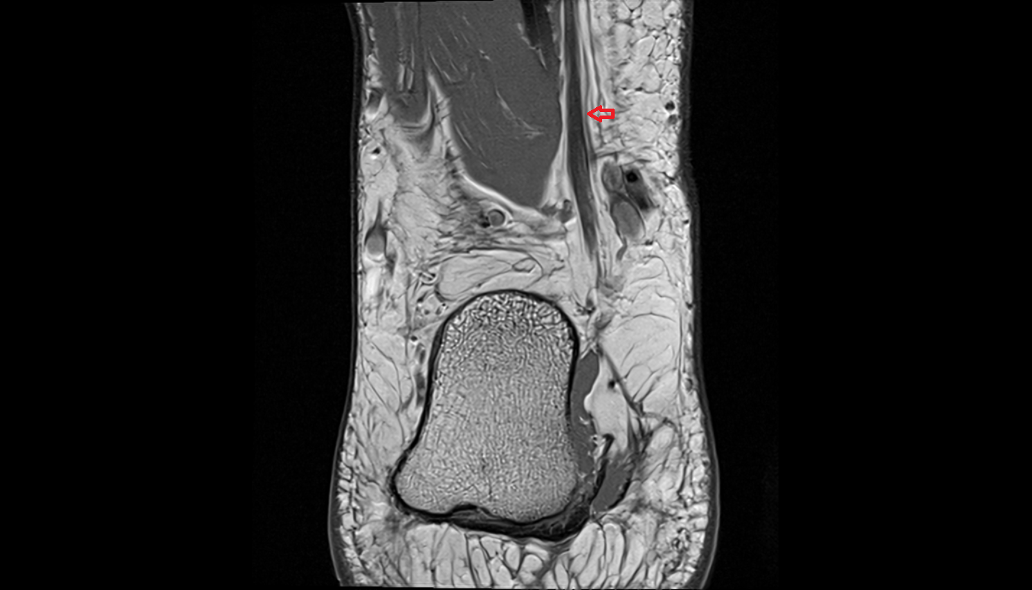Medial calcaneal nerve  coronal  cross sectional anatomy 3T MRI AI enhanced radiology image-img-00000-00000