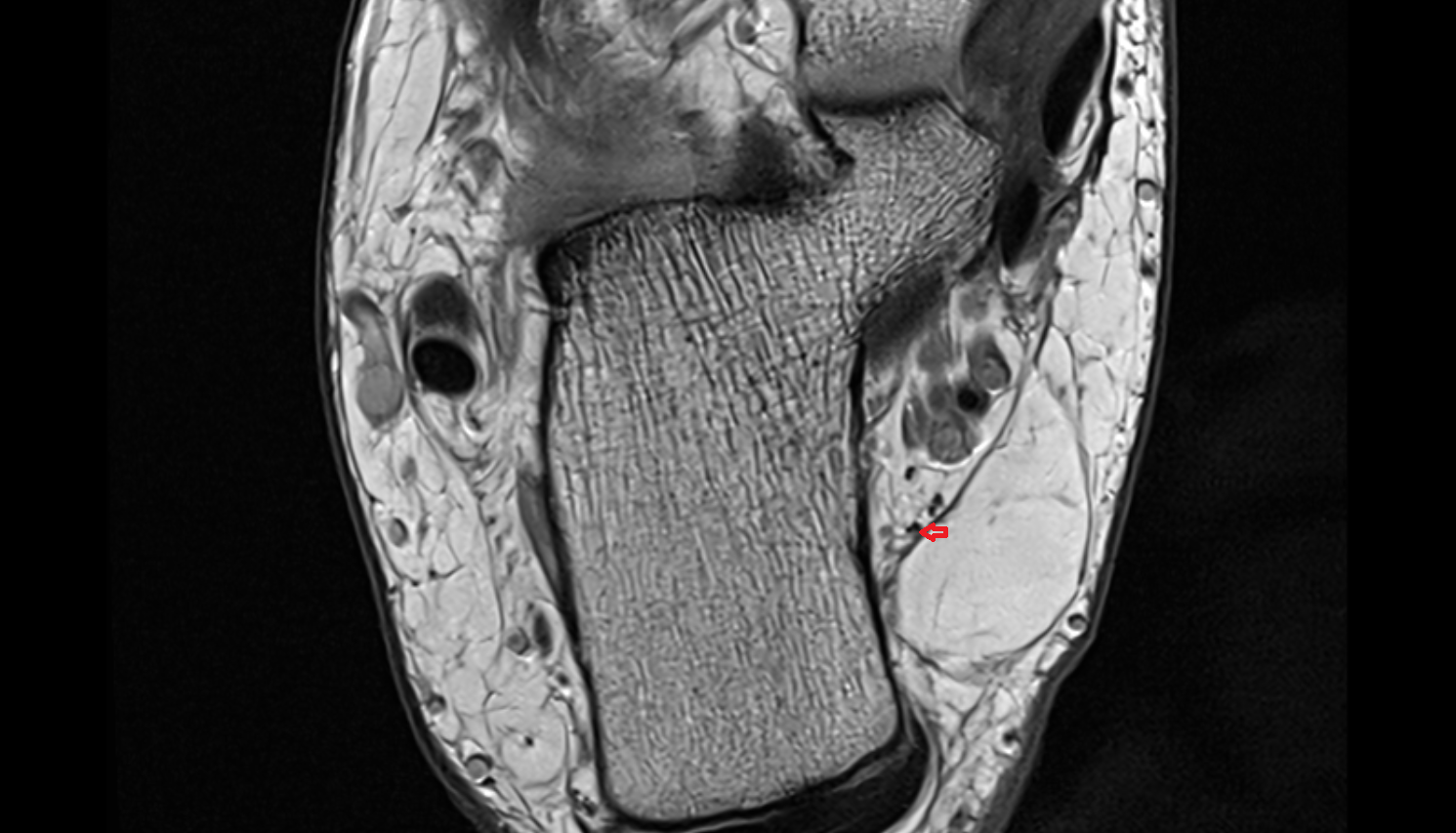 Medial calcaneal nerve (posterior cutaneous branches) axial cross sectional anatomy 3T MRI AI enhanced radiology image-img-00000-00000
