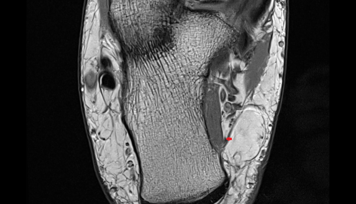 Medial calcaneal nerve (posterior cutaneous branches) axial cross sectional anatomy 3T MRI AI enhanced radiology image-img-00000-00000_00001