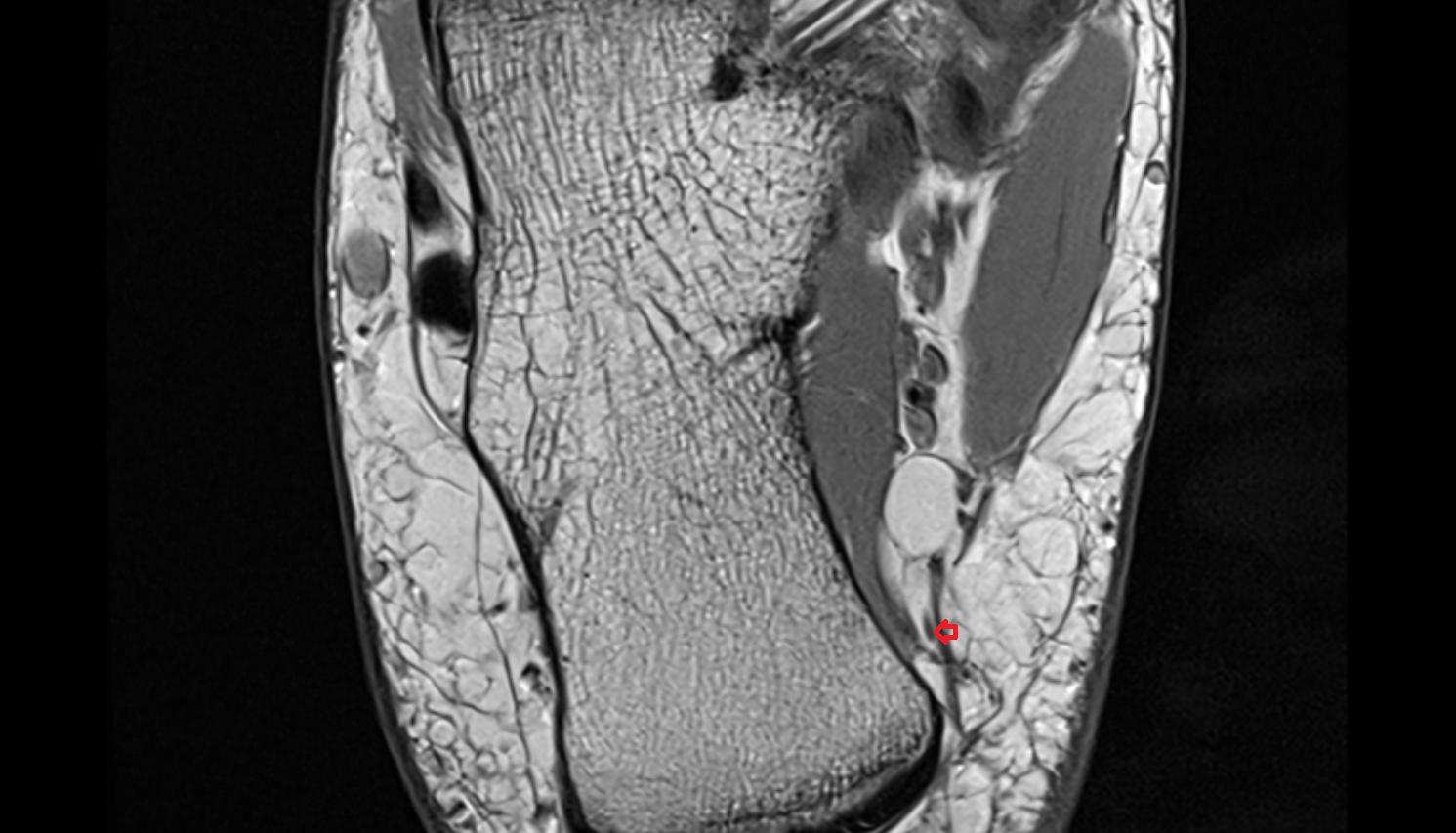 Medial calcaneal nerve (posterior cutaneous branches) axial cross sectional anatomy 3T MRI AI enhanced radiology image-img-00000-00000_00002