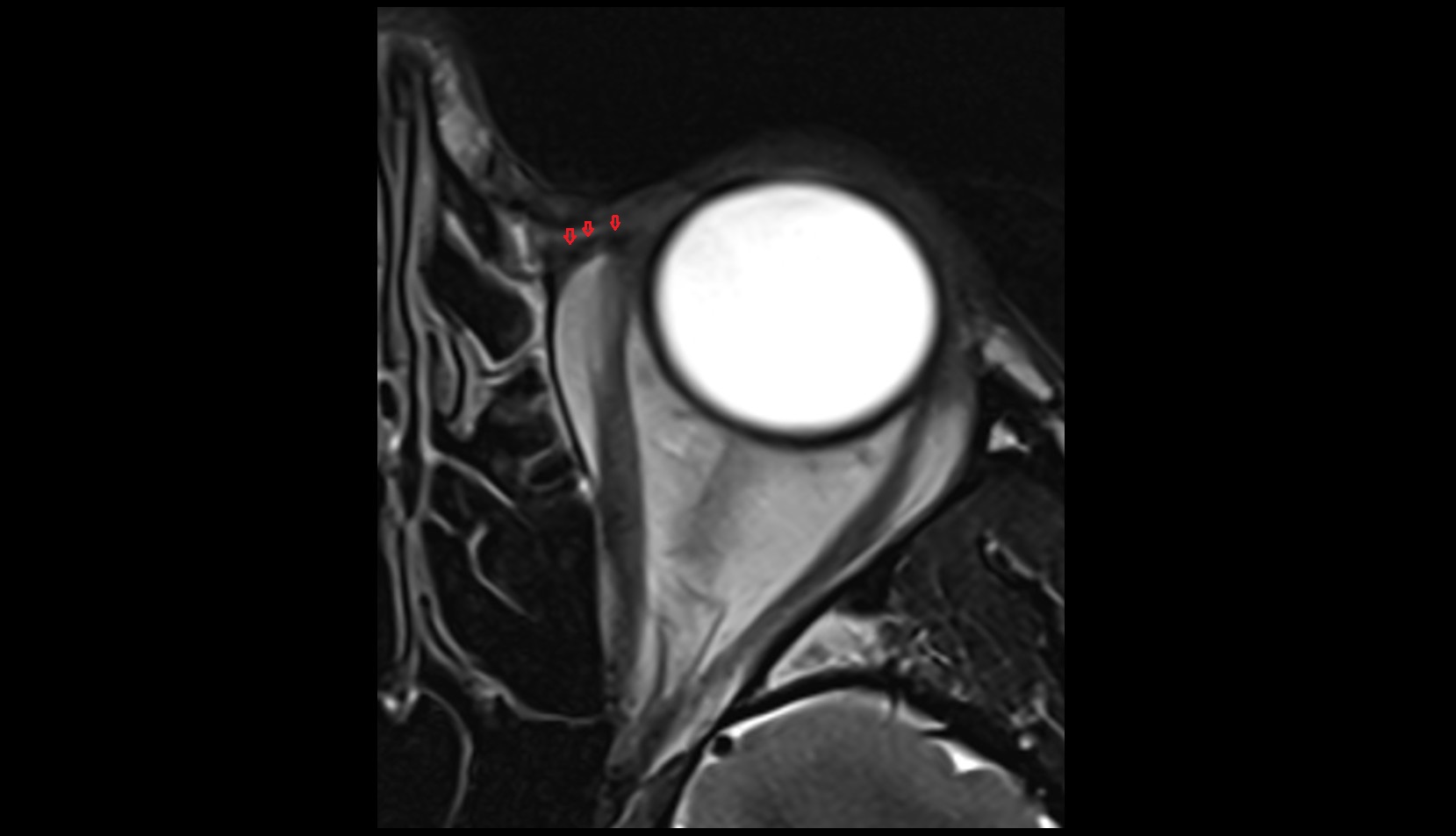 Medial canthal ligament MRI image