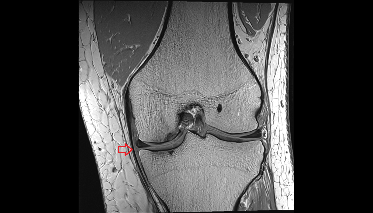 Medial collateral ligament (MCL)  coronal cross sectional anatomy 3T MRI AI enhanced  radiology  anatomy image-img-00000-00000