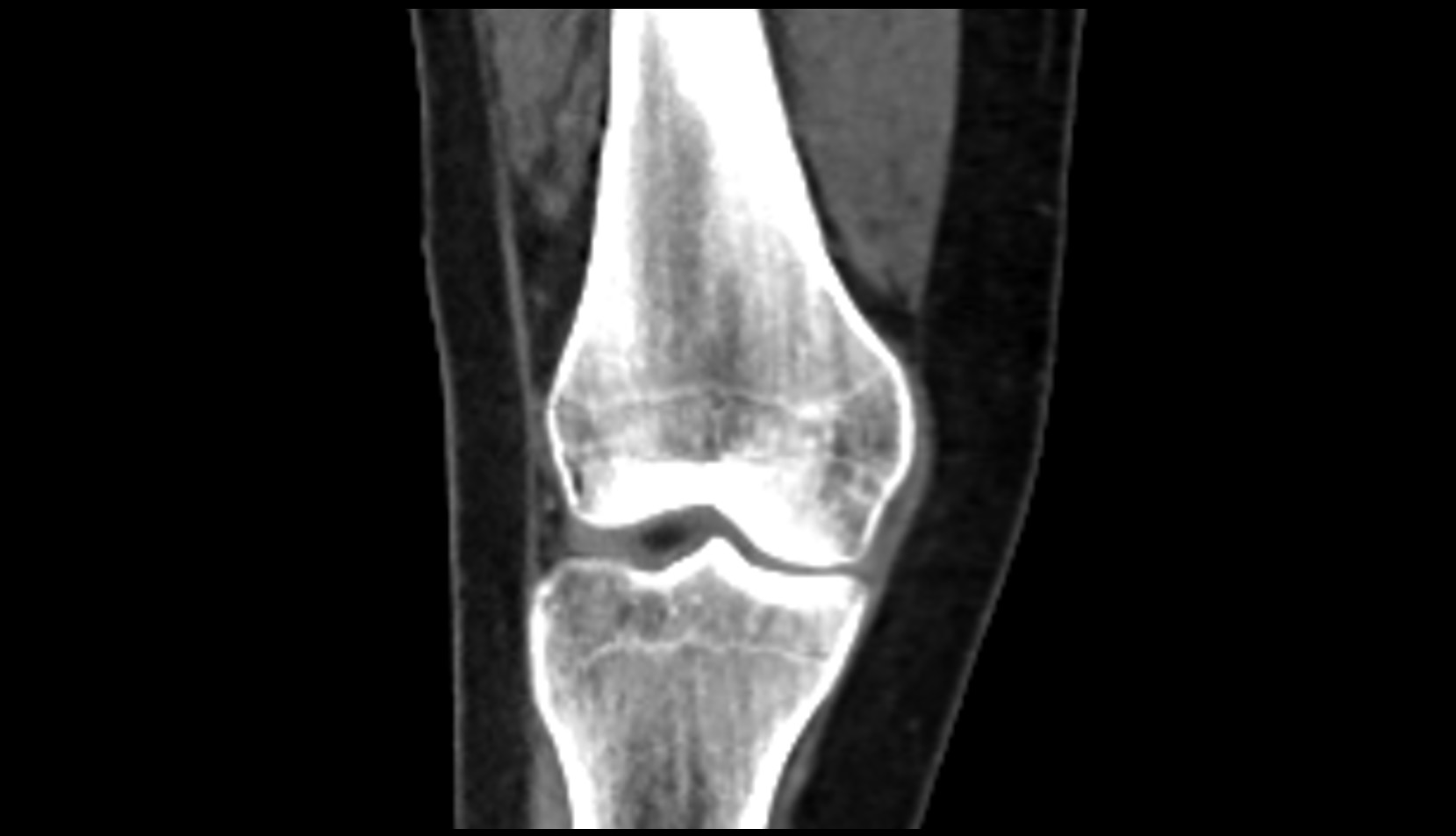 Medial collateral ligament (MCL) ct coronal image