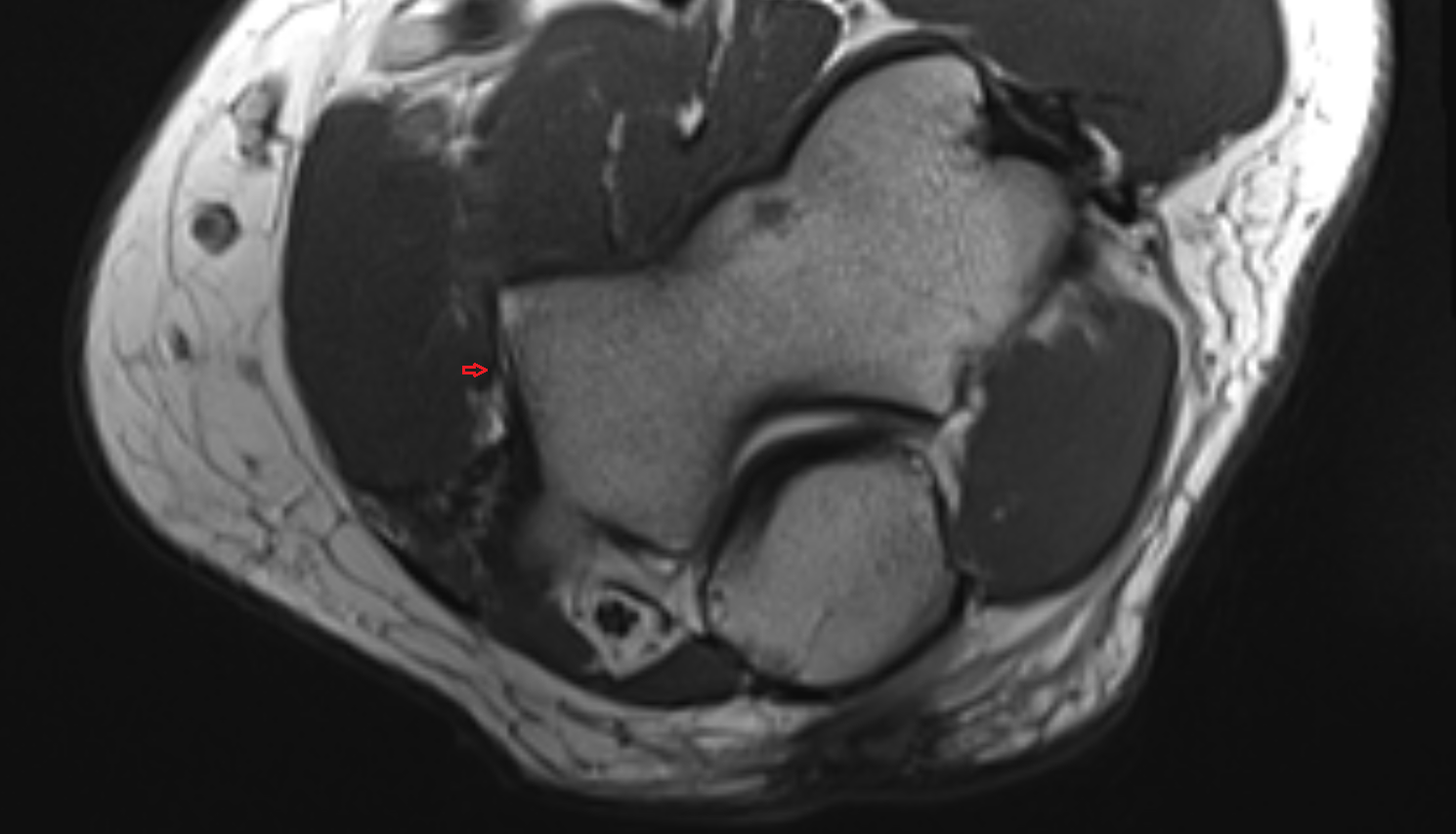 Medial collateral ligament of elbow anterior bundle axial cross sectional anatomy 3T MRI AI enhanced radiology image -img-00000-00000
