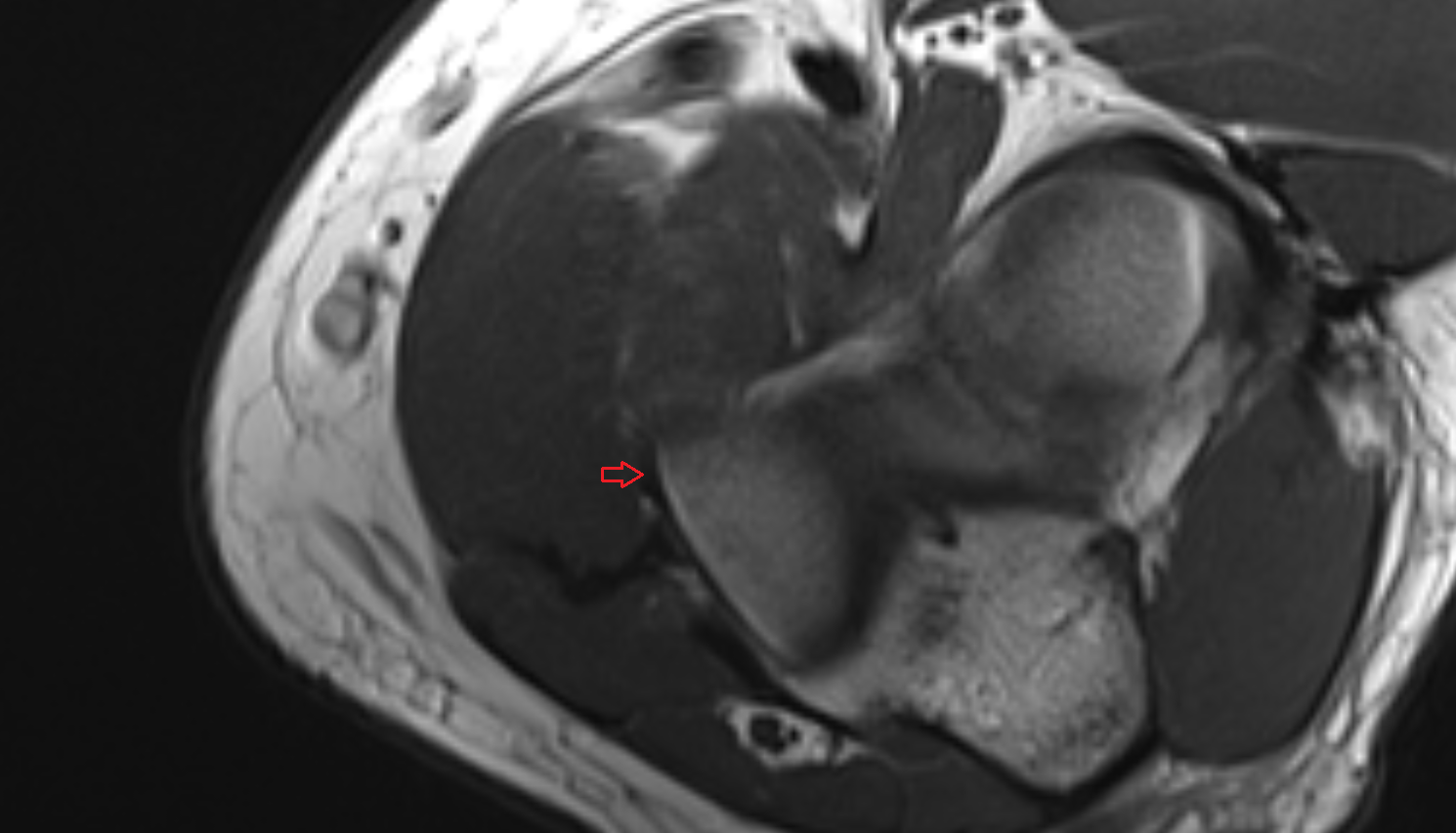Medial collateral ligament of elbow anterior bundle axial cross sectional anatomy 3T MRI AI enhanced radiology image -img-00000-00000_00001