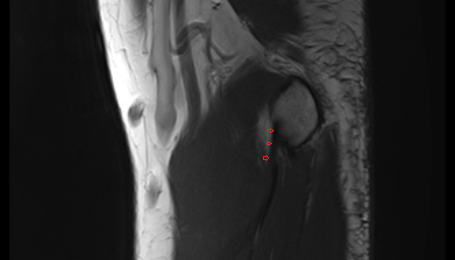 Medial collateral ligament of elbow anterior bundle sag cross sectional anatomy 3T MRI AI enhanced radiology image -img-00000-00000