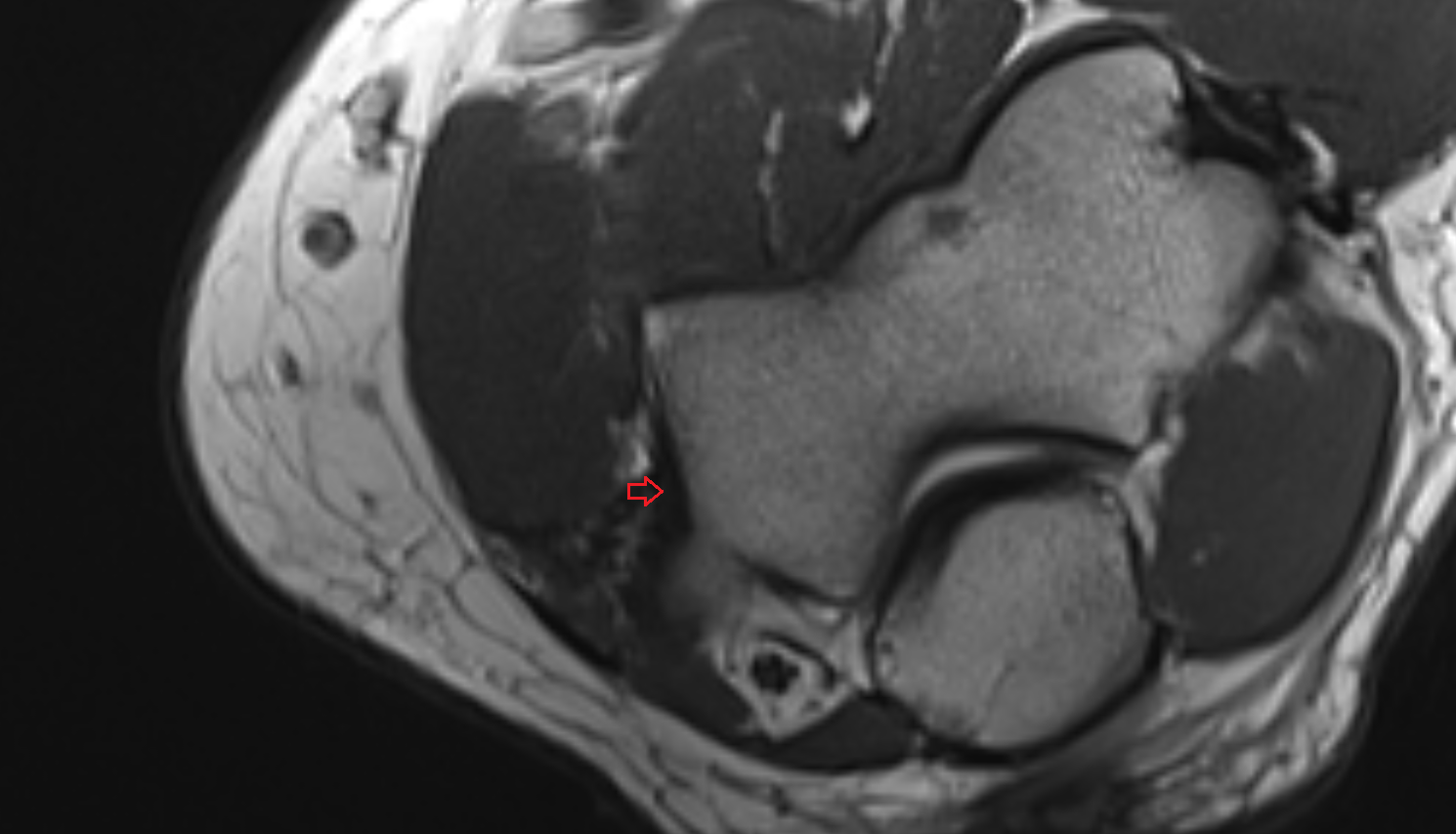 Medial collateral ligament of elbow posterio bundle axial cross sectional anatomy 3T MRI AI enhanced radiology image -img-00000-00000