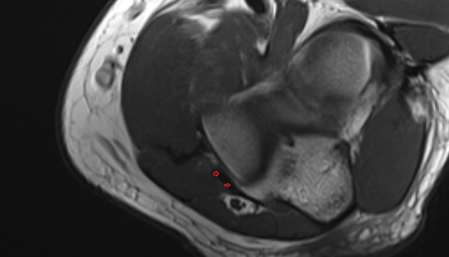 Medial collateral ligament of elbow posterio bundle axial cross sectional anatomy 3T MRI AI enhanced radiology image -img-00000-00000_00002