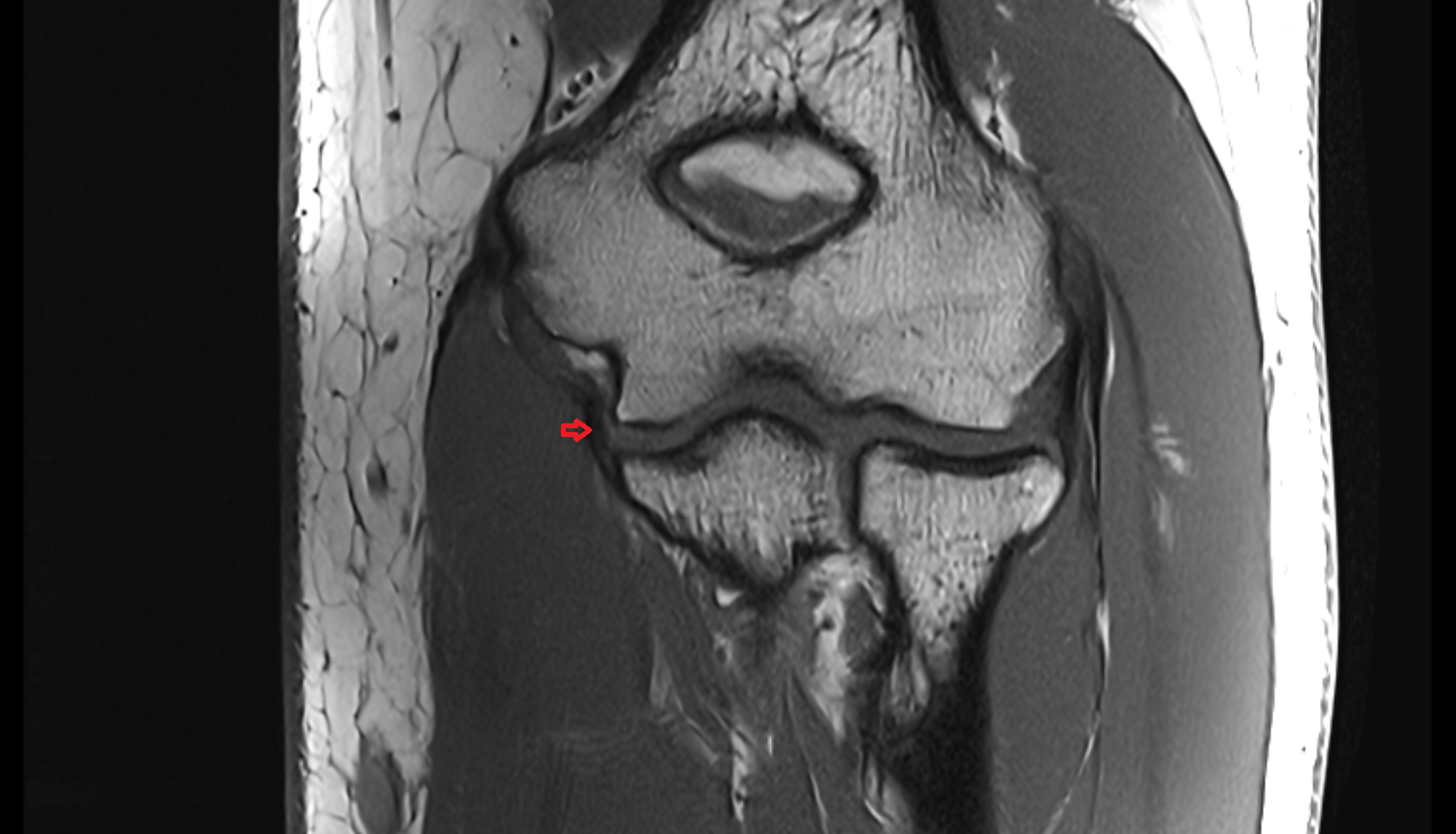 Medial collateral ligament of elbow posterior bundle coronal cross sectional anatomy 3T MRI AI enhanced radiology image -img-00000-00000