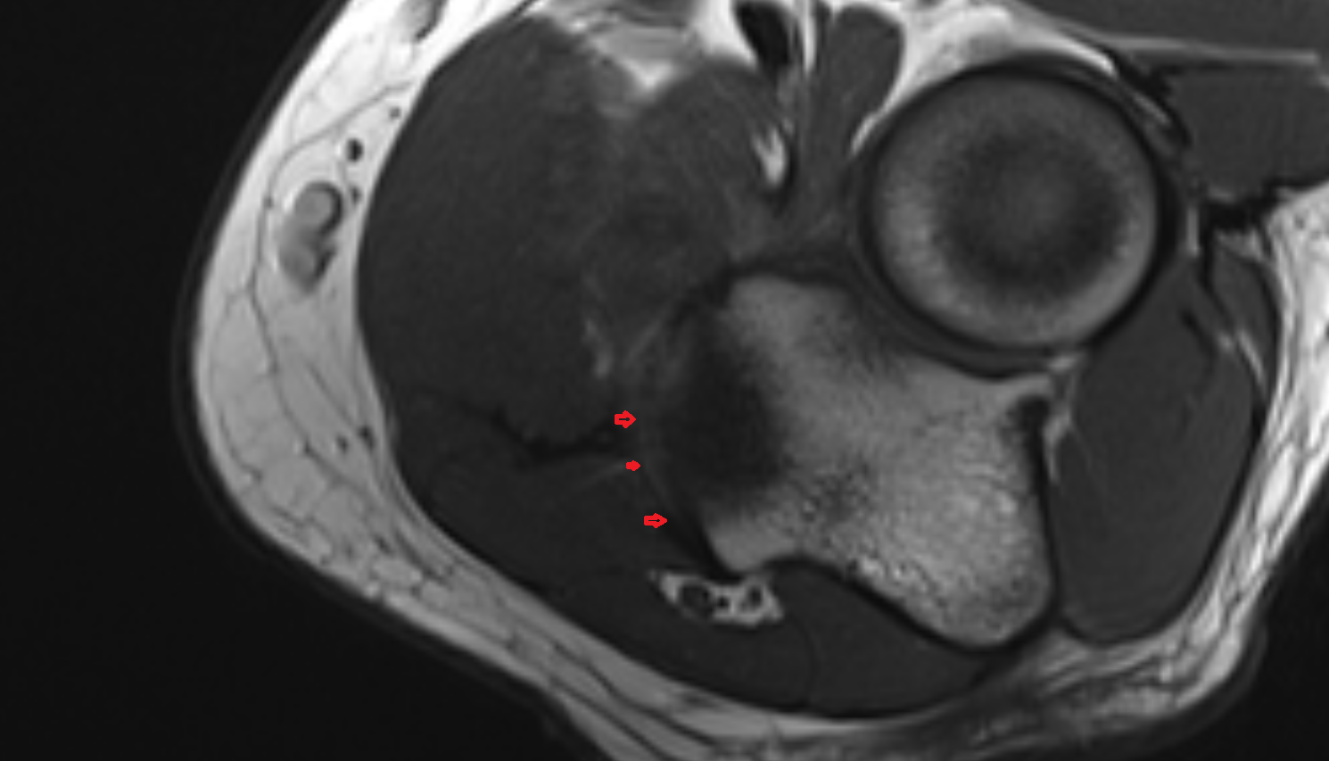 Medial collateral ligament of elbow transverse bundle axial cross sectional anatomy 3T MRI AI enhanced radiology image -img-00000-00000