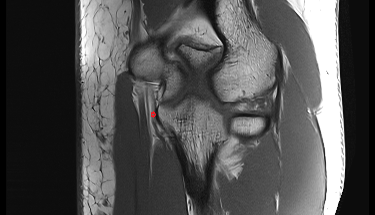Medial collateral ligament of elbow transverse bundle coronal cross sectional anatomy 3T MRI AI enhanced radiology image -img-00000-00000