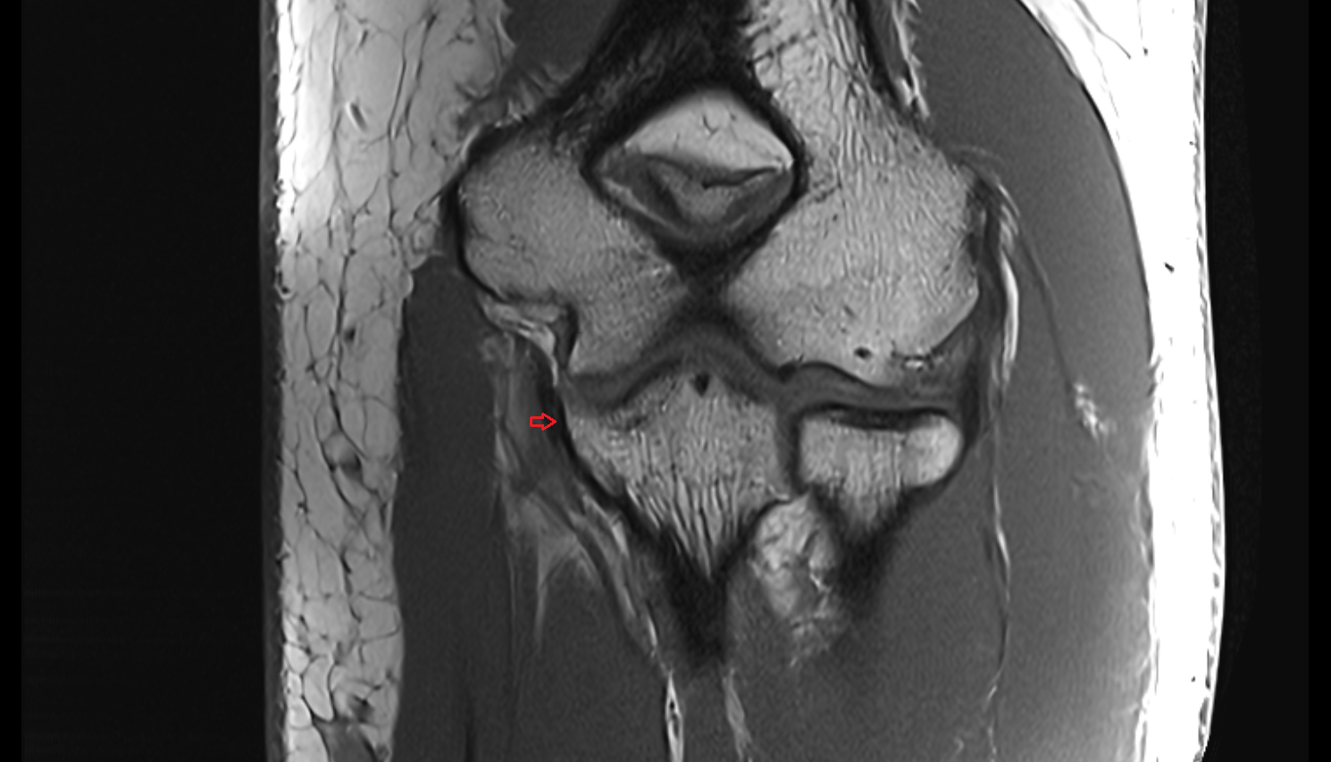 Medial collateral ligament of elbow transverse bundle coronal cross sectional anatomy 3T MRI AI enhanced radiology image -img-00000-00000_00001