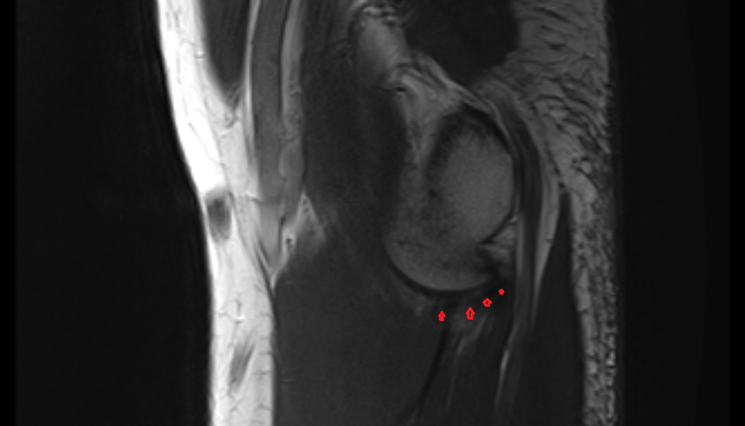 Medial collateral ligament of elbow transverse bundle sag cross sectional anatomy 3T MRI AI enhanced radiology image -img-00000-00000_00002