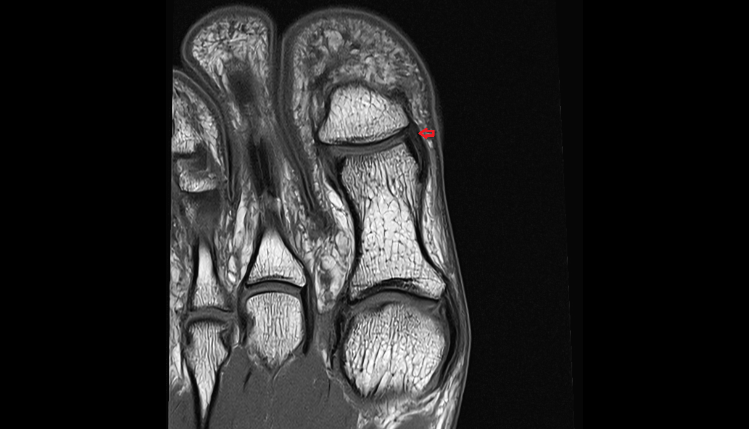 Medial collateral ligament of interphalangeal joint of foot  coronal cross sectional anatomy 3T MRI AI enhanced radiology image-img-00000-00000