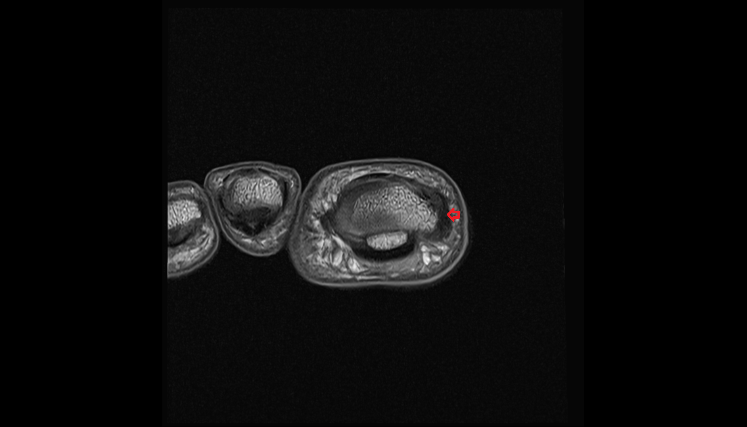 Medial collateral ligament of interphalangeal joint of foot  coronal cross sectional anatomy 3T MRI AI enhanced radiology image-img-00000-00000_00001