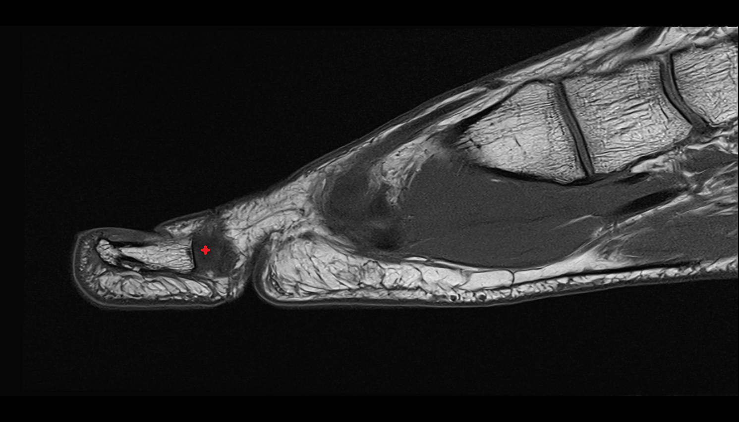 Medial collateral ligament of interphalangeal joint of foot  sag cross sectional anatomy 3T MRI AI enhanced radiology image-img-00000-00000_00001