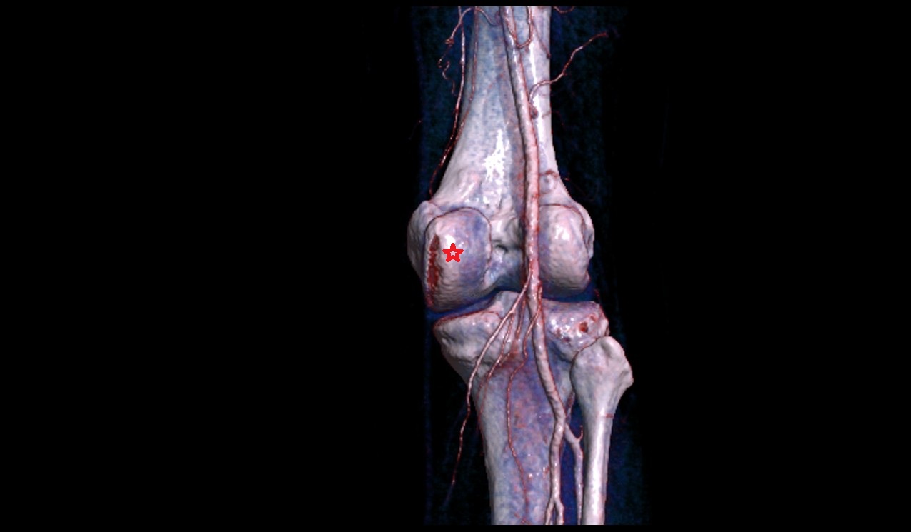 Medial condyle of femur 3d image