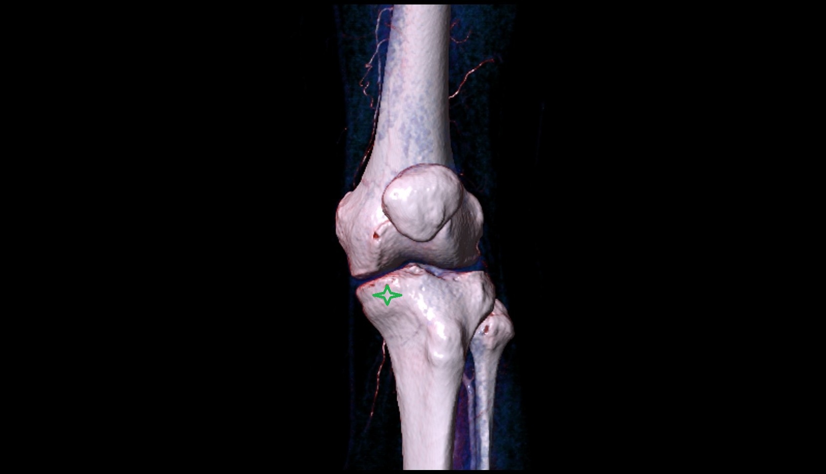 Medial condyle of tibia 3d