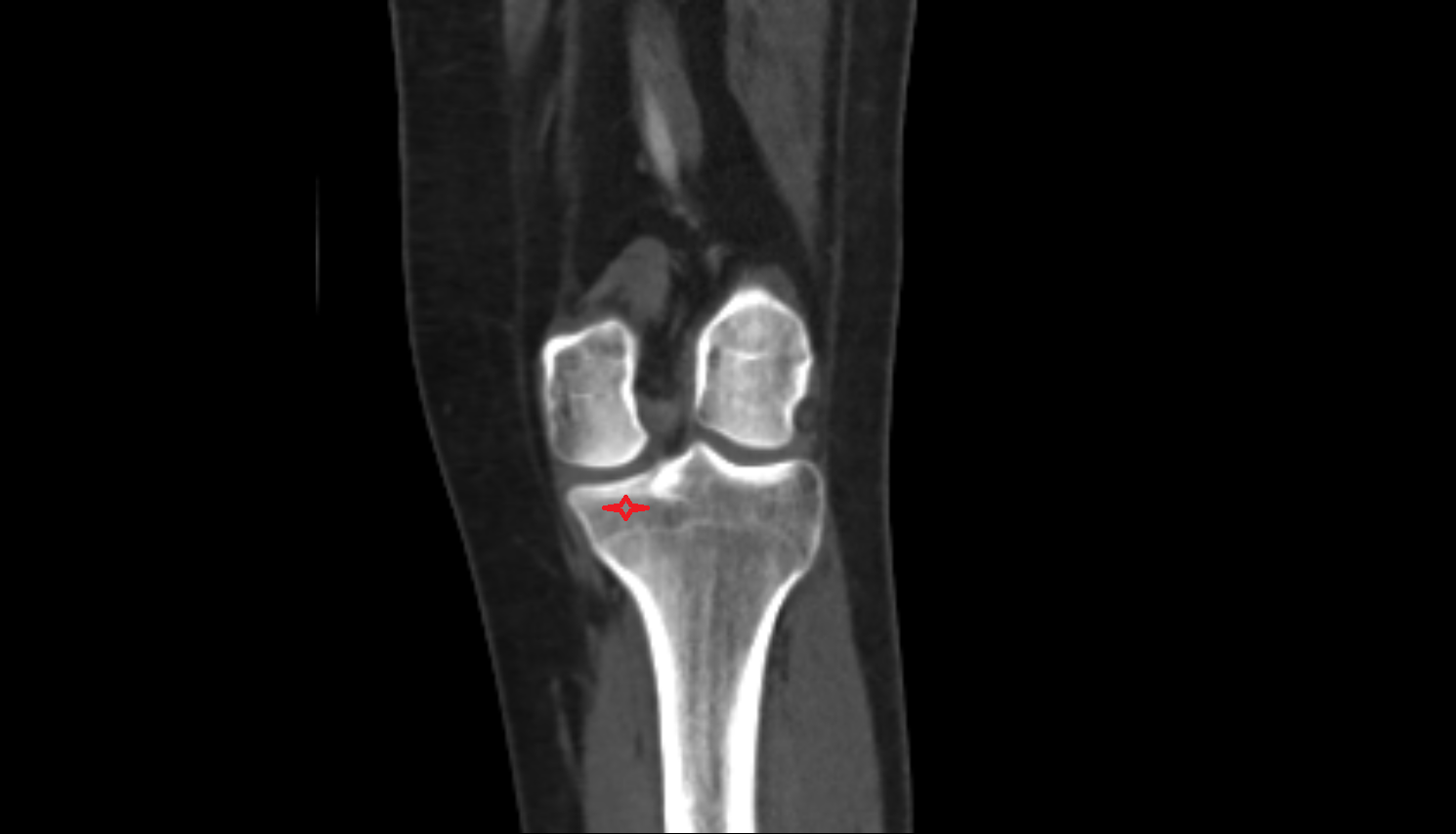 Medial condyle of tibia ct anatomy labelled image-img-00000-00000
