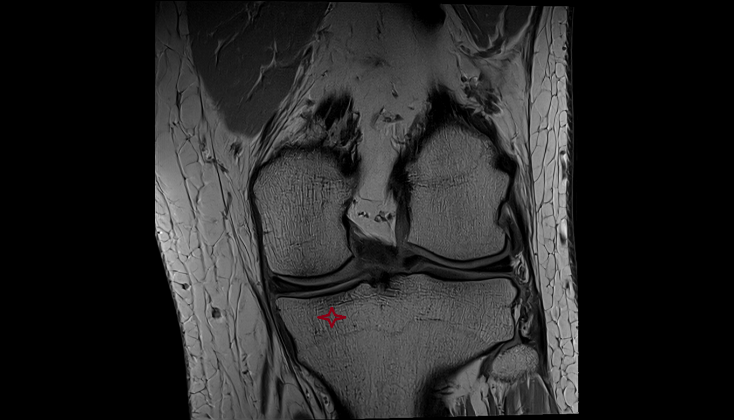 Medial condyle of tibia  mri anatomy labelled image-img-00000-00000