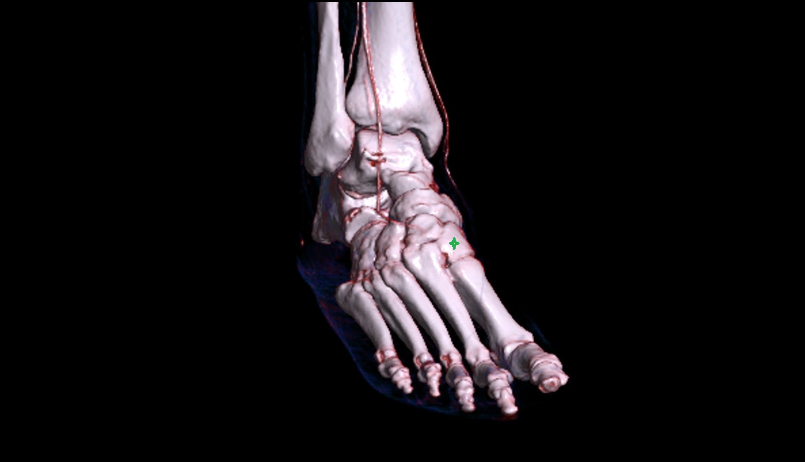 Medial cuneiform bone 3d