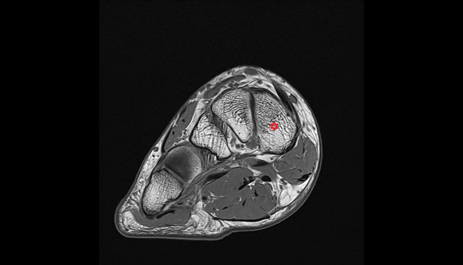 Medial cuneiform bone   MRI coronal  cross sectional anatomy 3T MRI AI enhanced radiology image-img-00000-00000