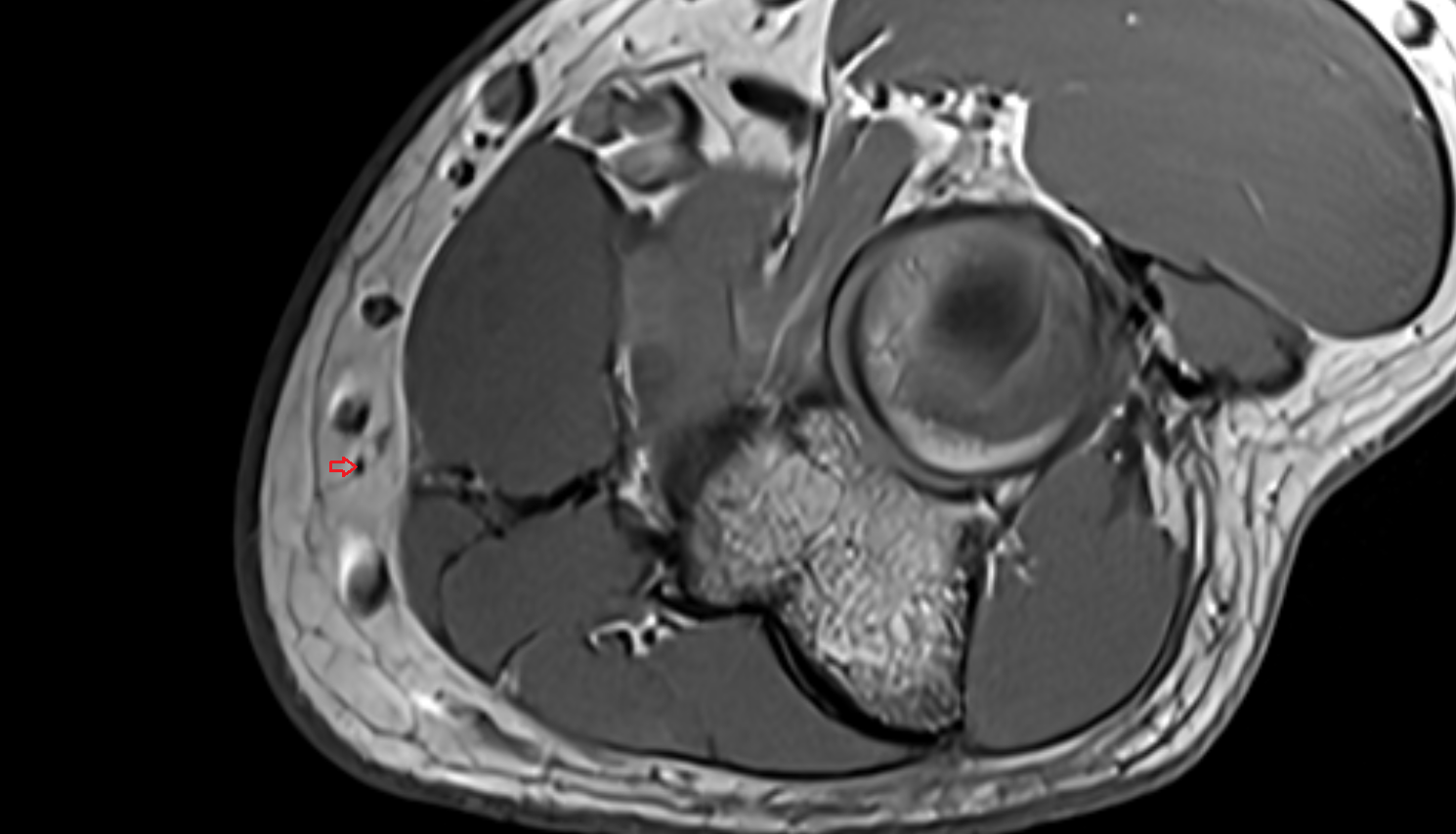 Medial cutaneous nerve of forearm (anterior branch)  axial cross sectional anatomy 3T MRI AI enhanced radiology image -img-00000-00000