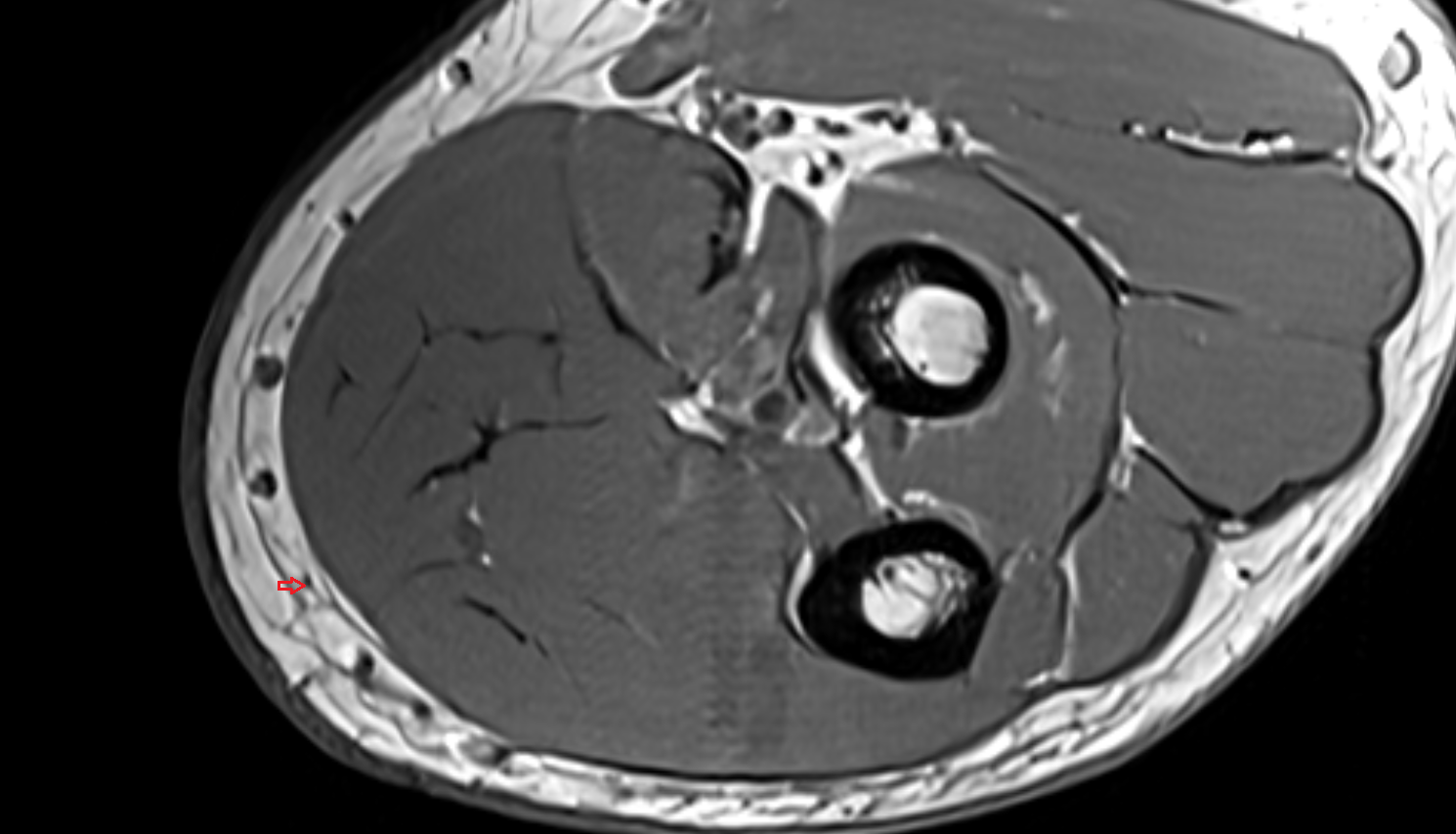 Medial cutaneous nerve of forearm (anterior branch)  axial cross sectional anatomy 3T MRI AI enhanced radiology image -img-00000-00000_00001