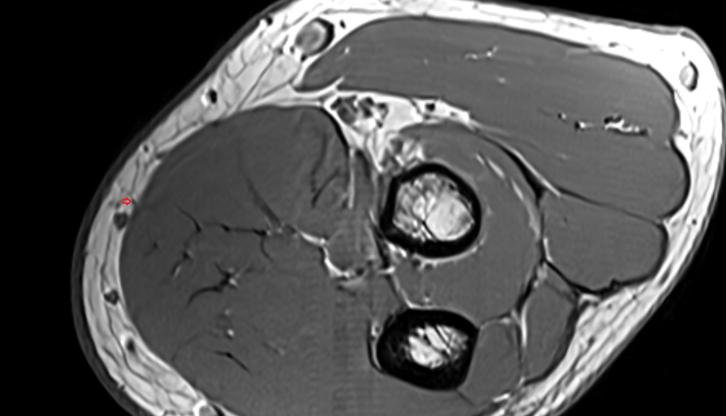 Medial cutaneous nerve of forearm (anterior branch)  axial cross sectional anatomy 3T MRI AI enhanced radiology image -img-00000-00000_00002