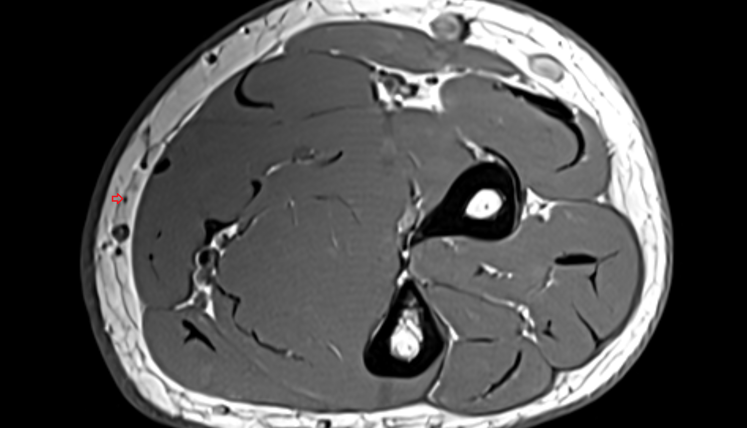 Medial cutaneous nerve of forearm (anterior branch)  axial cross sectional anatomy 3T MRI AI enhanced radiology image -img-00000-00000_00003