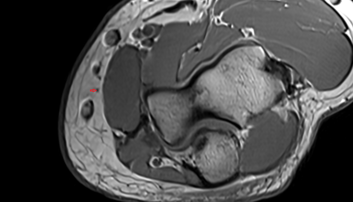Medial cutaneous nerve of forearm (anterior branch)  axial cross sectional anatomy 3T MRI AI enhanced radiology image -img-00000-00000_00005