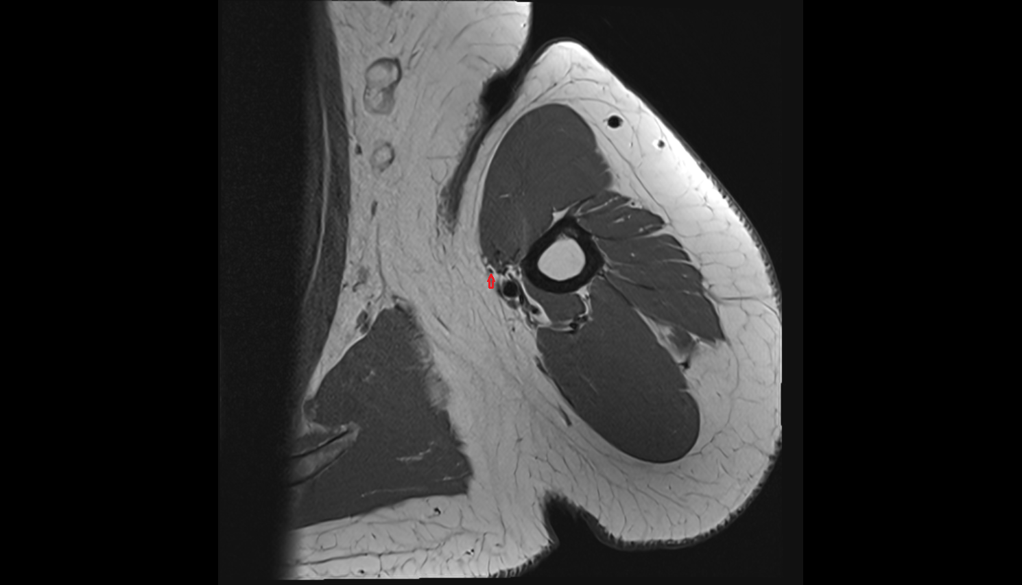Medial cutaneous nerve of forearm  axial cross sectional anatomy 3T MRI AI enhanced radiology image-img-00000-00000