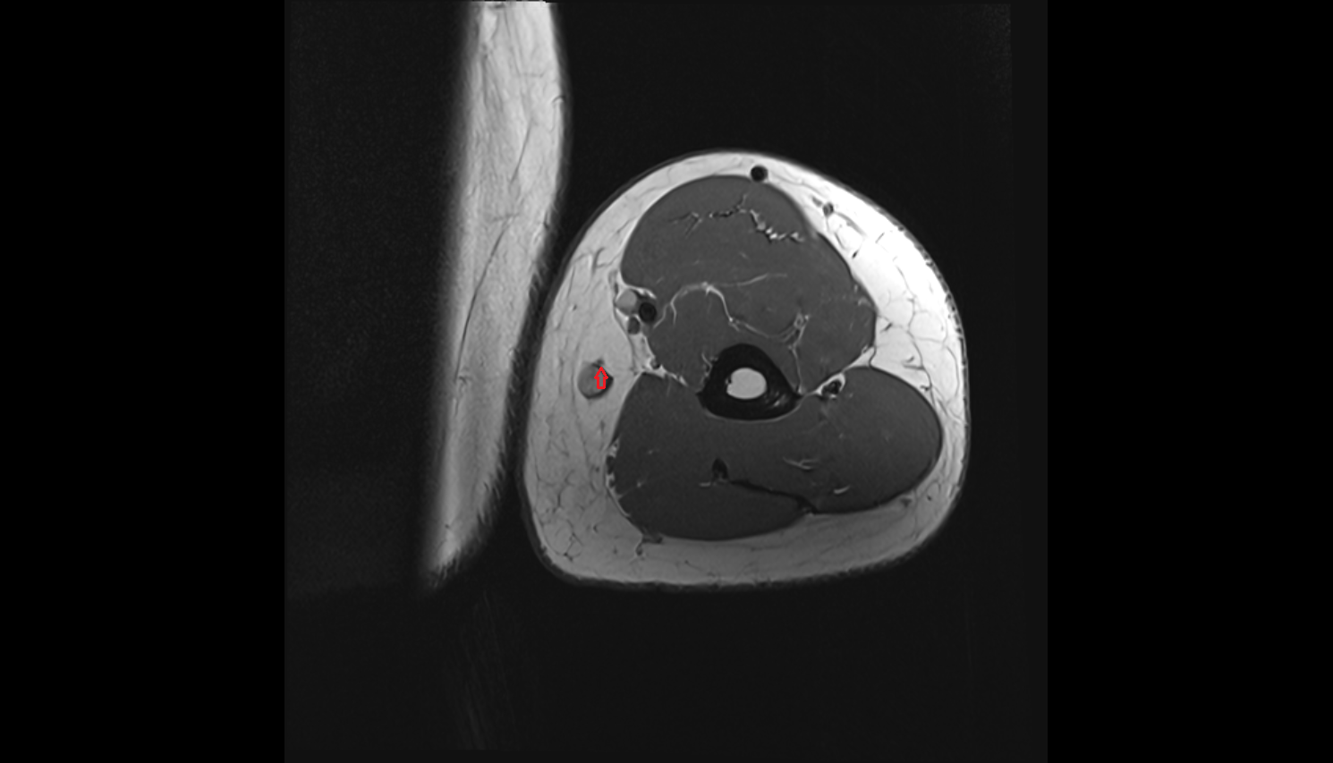 Medial cutaneous nerve of forearm  axial cross sectional anatomy 3T MRI AI enhanced radiology image-img-00000-00000_00002