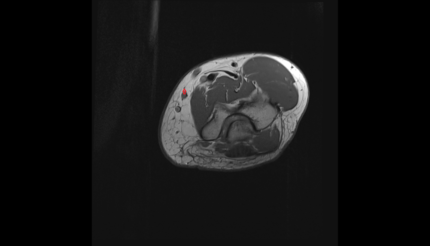 Medial cutaneous nerve of forearm  axial cross sectional anatomy 3T MRI AI enhanced radiology image-img-00000-00000_00003