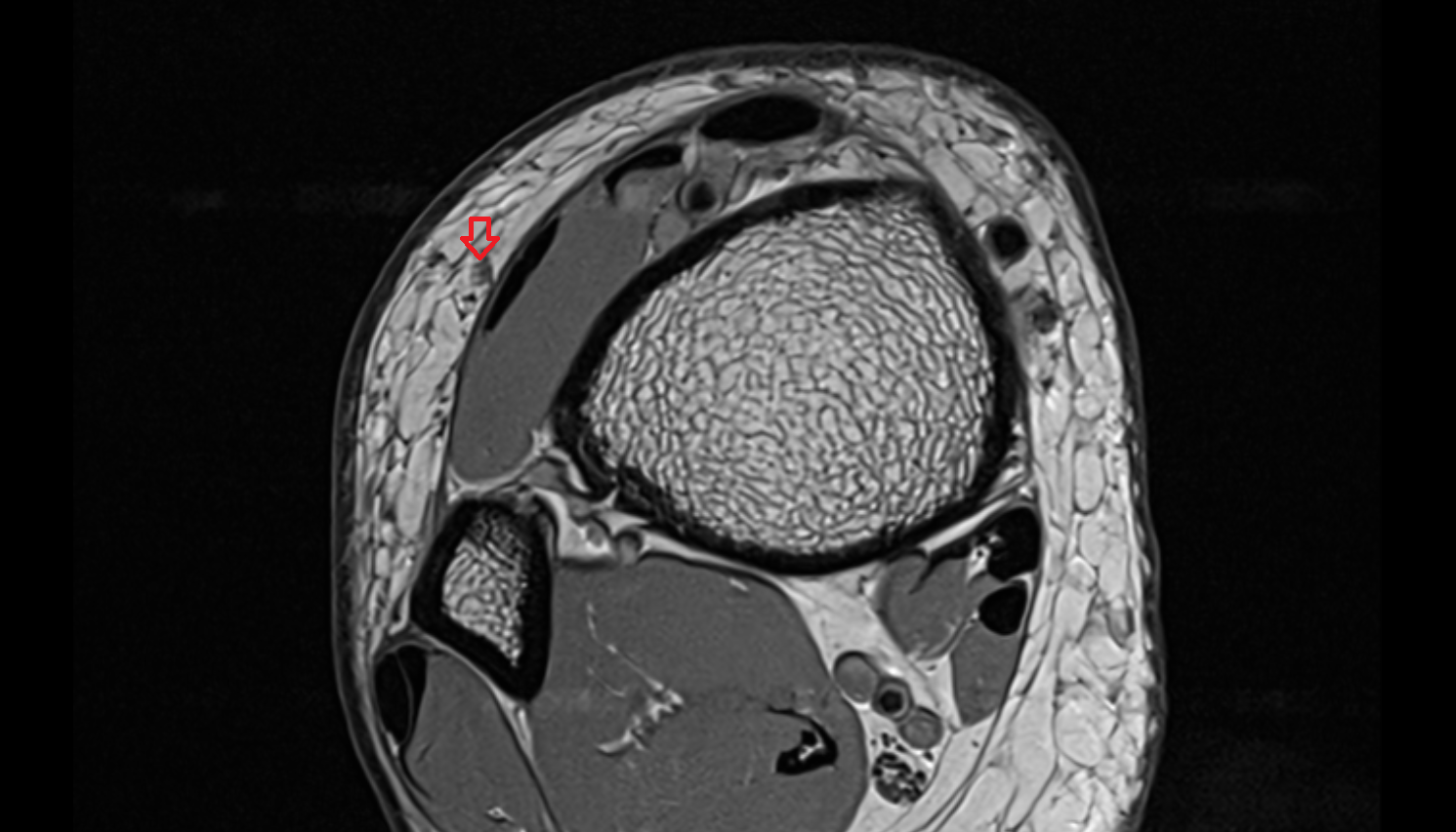 Medial dorsal cutaneous nerve axial cross sectional anatomy 3T MRI AI enhanced radiology image-img-00000-00000