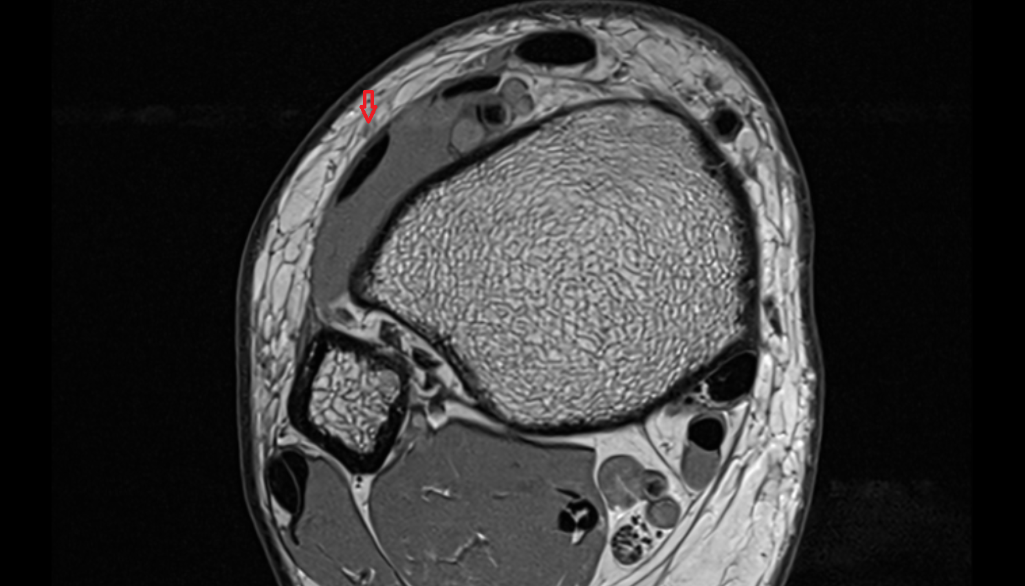 Medial dorsal cutaneous nerve axial cross sectional anatomy 3T MRI AI enhanced radiology image-img-00000-00000_00001