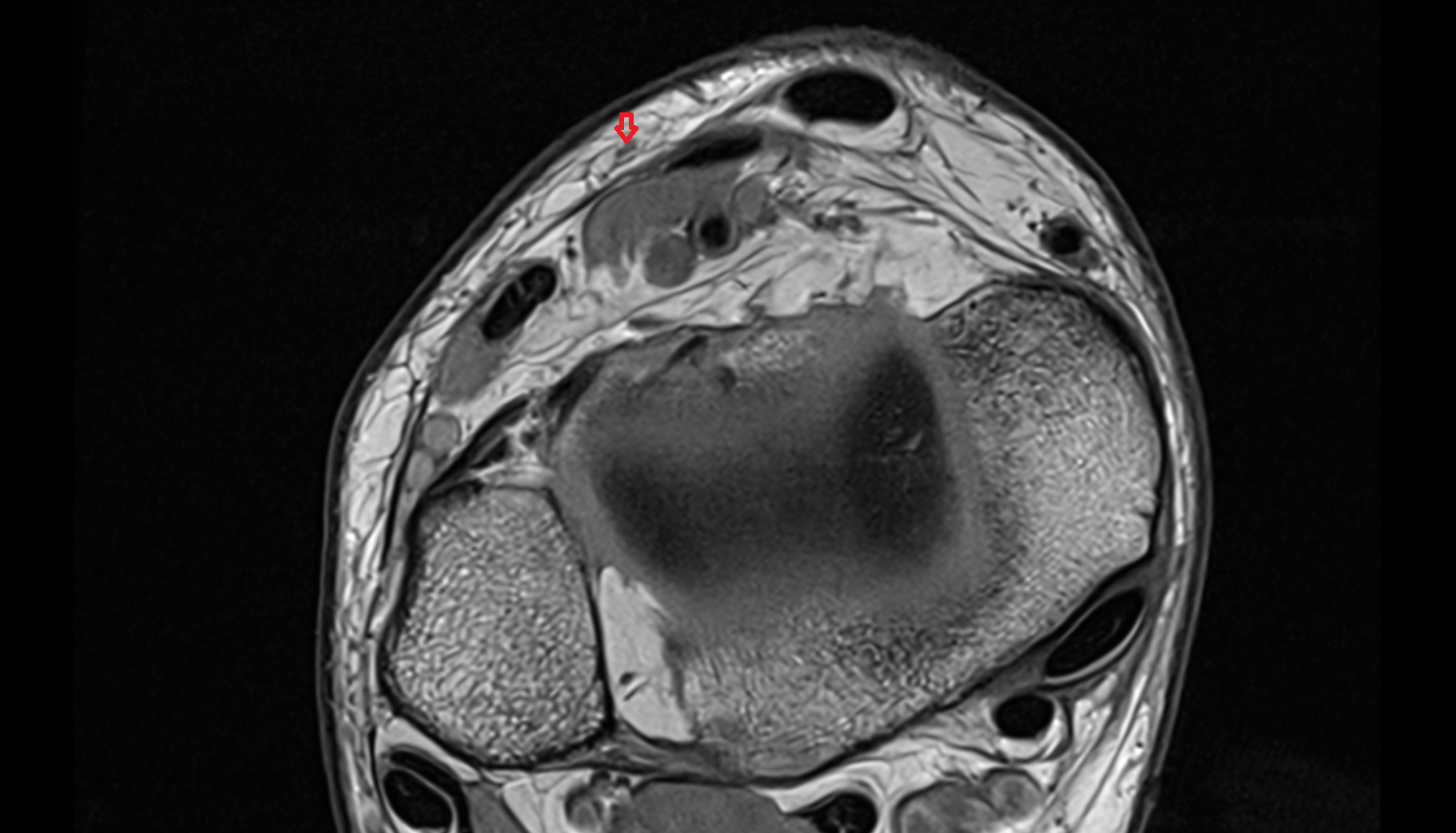 Medial dorsal cutaneous nerve axial cross sectional anatomy 3T MRI AI enhanced radiology image-img-00000-00000_00002