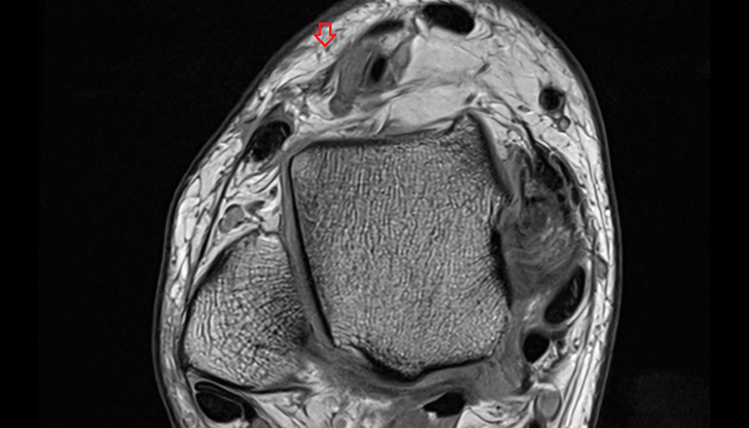 Medial dorsal cutaneous nerve axial cross sectional anatomy 3T MRI AI enhanced radiology image-img-00000-00000_00003