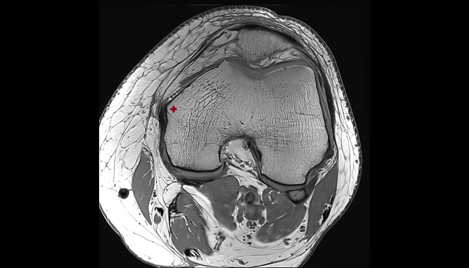 Medial epicondyle of femur axial cross sectional anatomy 3T MRI AI enhanced  radiology  anatomy image-img-00000-00000