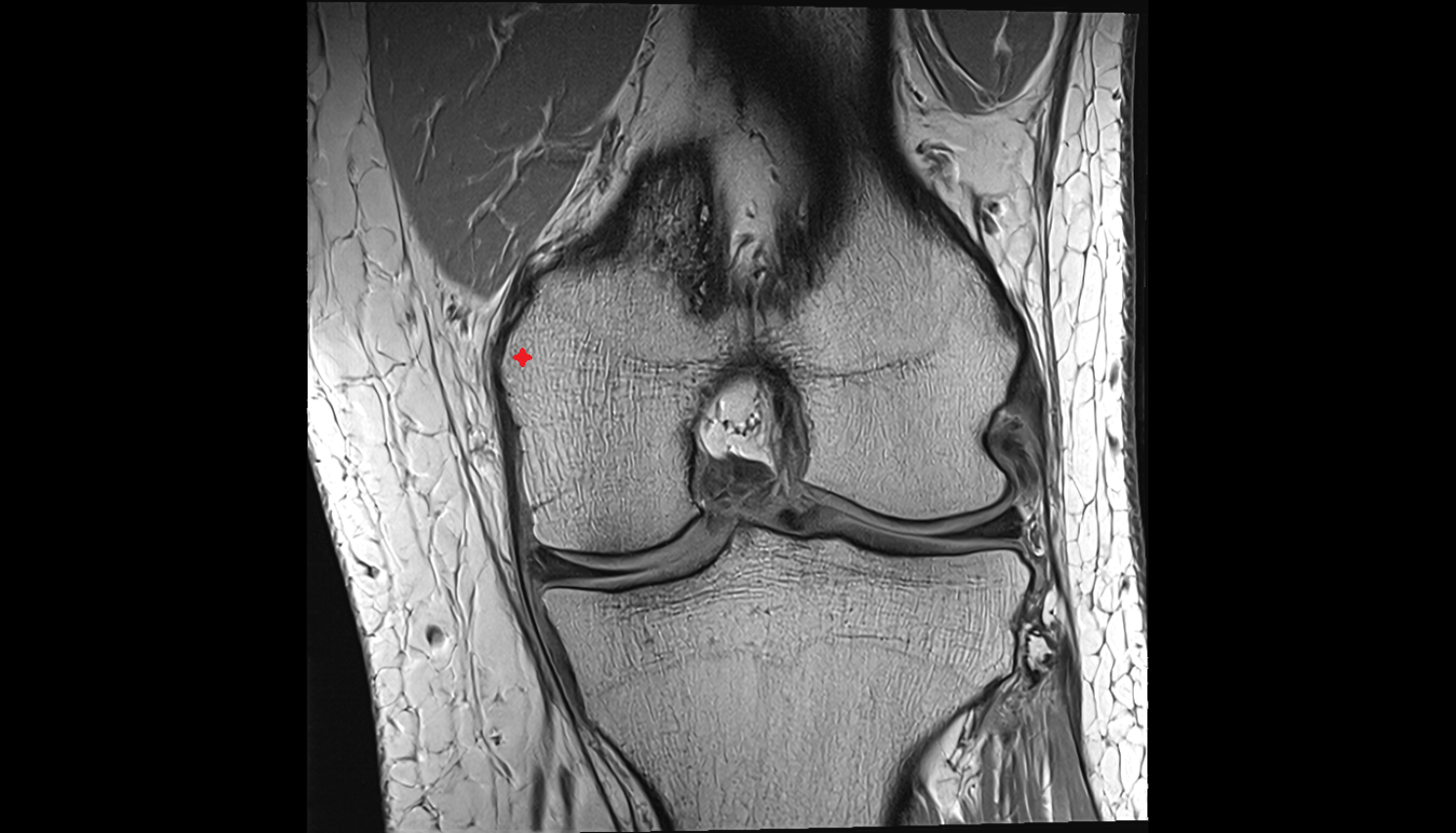 Medial epicondyle of femur  coronal cross sectional anatomy 3T MRI AI enhanced  radiology  anatomy image-img-00000-00000