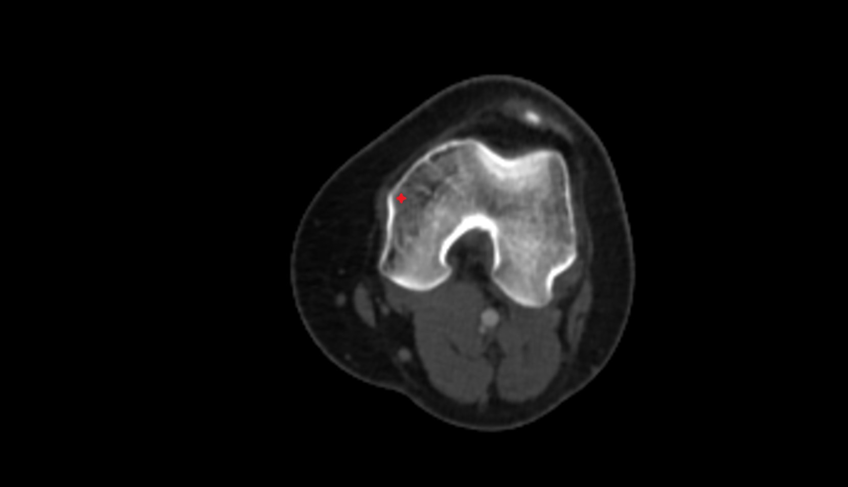 Medial epicondyle of femur ct axial