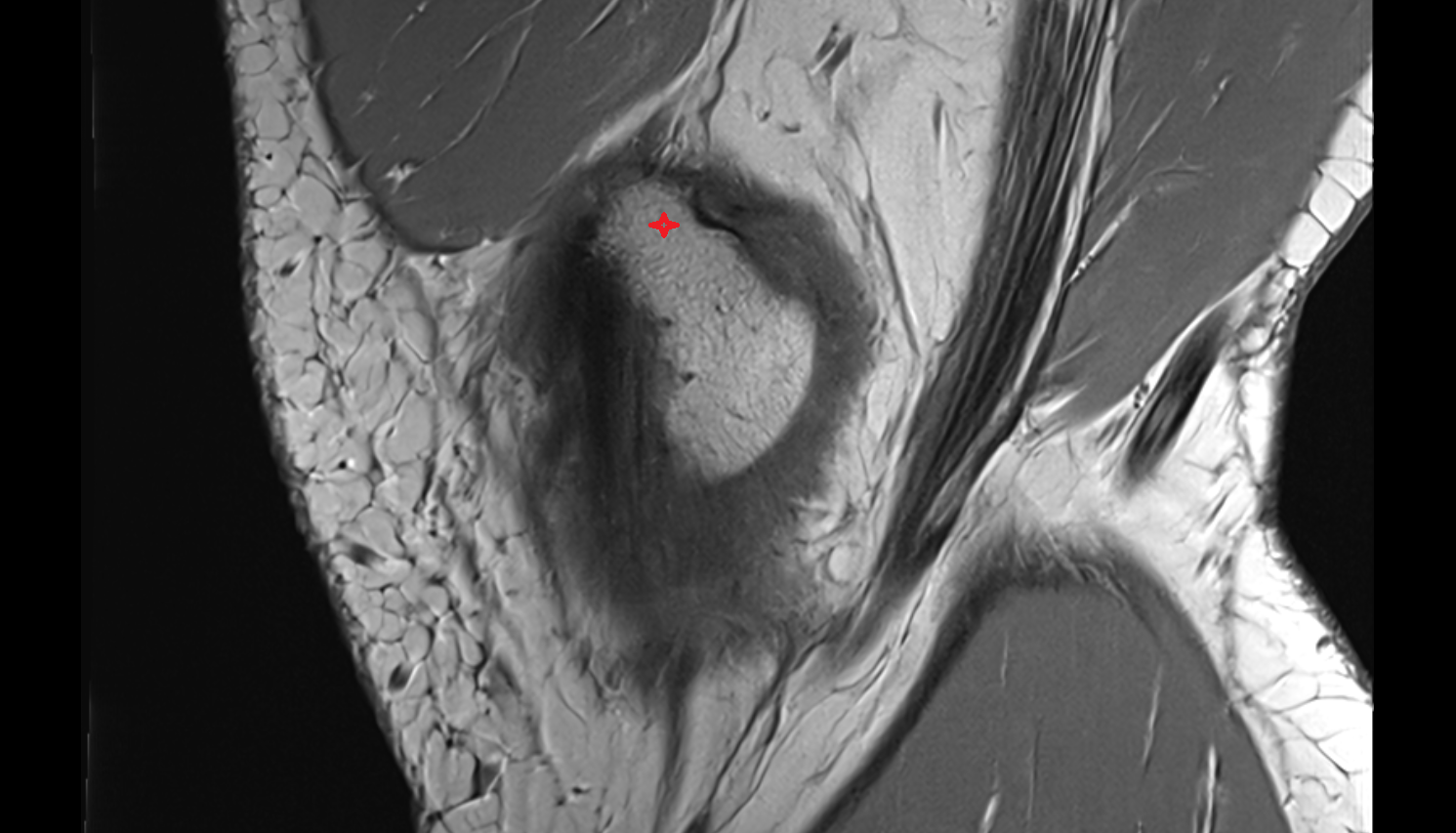Medial epicondyle of femur sagittal cross sectional anatomy 3T MRI AI enhanced  radiology  anatomy image-img-00000-00000