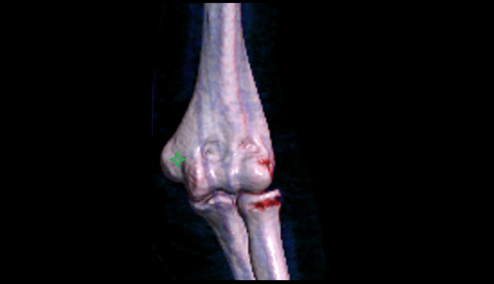 Medial epicondyle of humerus 3D VRT IMAGE