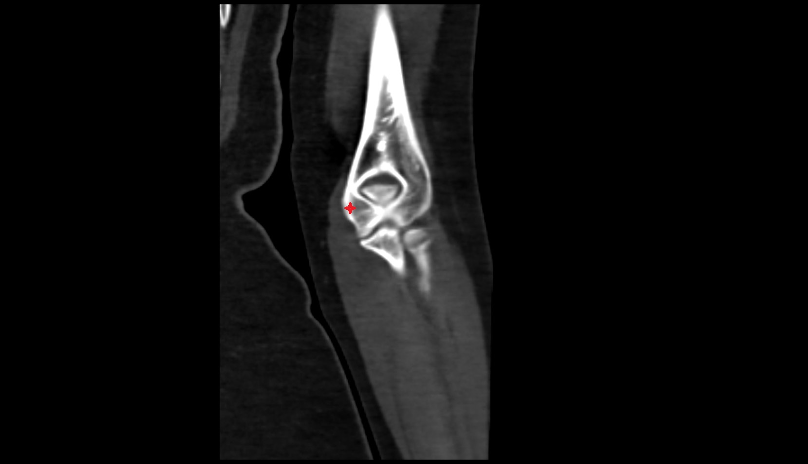 Medial epicondyle of humerus CT CORONAL IMAGE