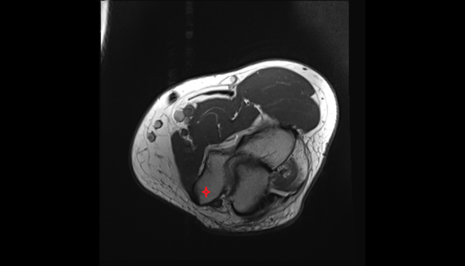 Medial epicondyle of humerus axial cross sectional anatomy 3T MRI AI enhanced radiology image -img-00000-00000