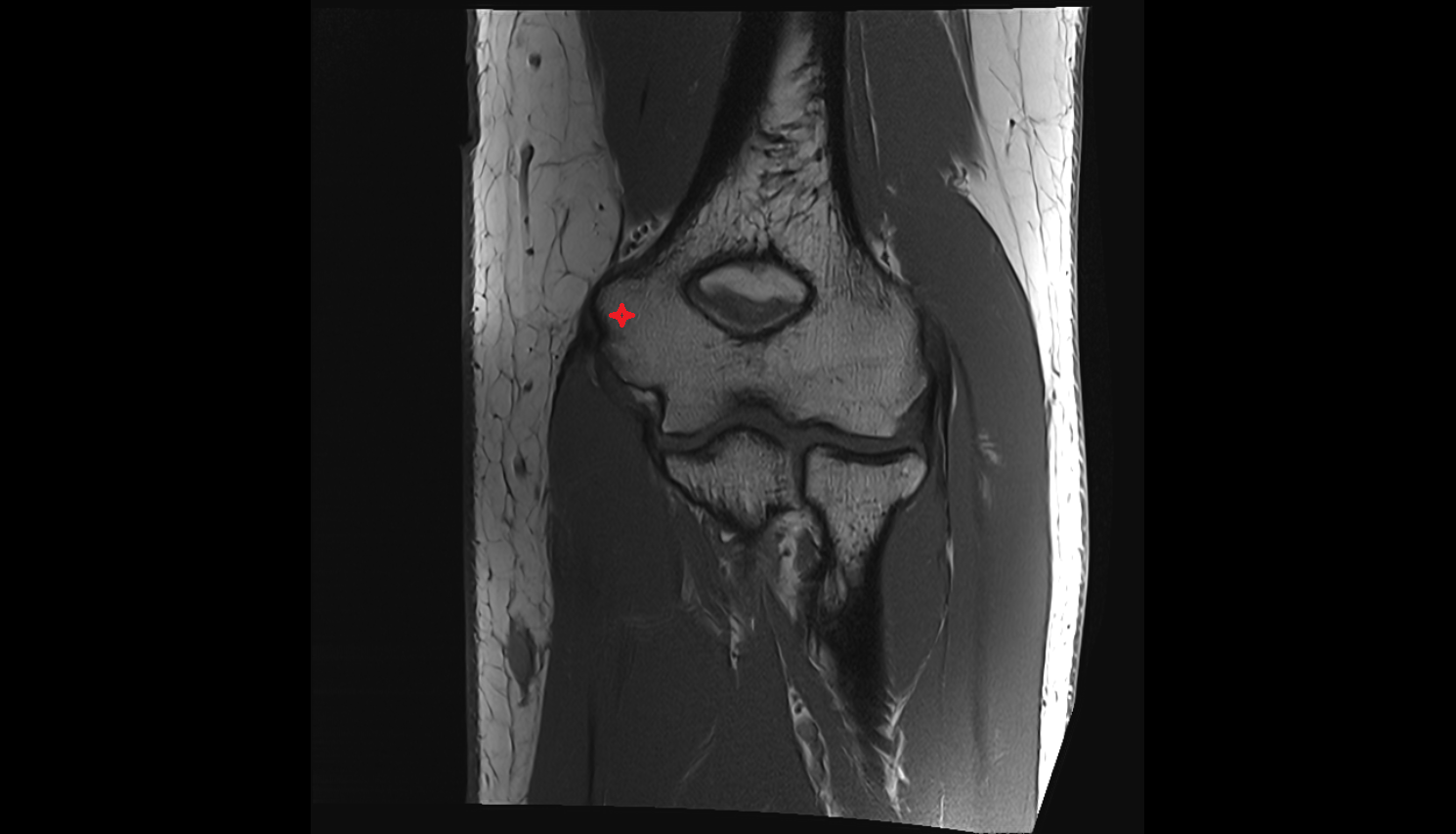 Medial epicondyle of humerus  coronal cross sectional anatomy 3T MRI AI enhanced radiology image -img-00000-00000