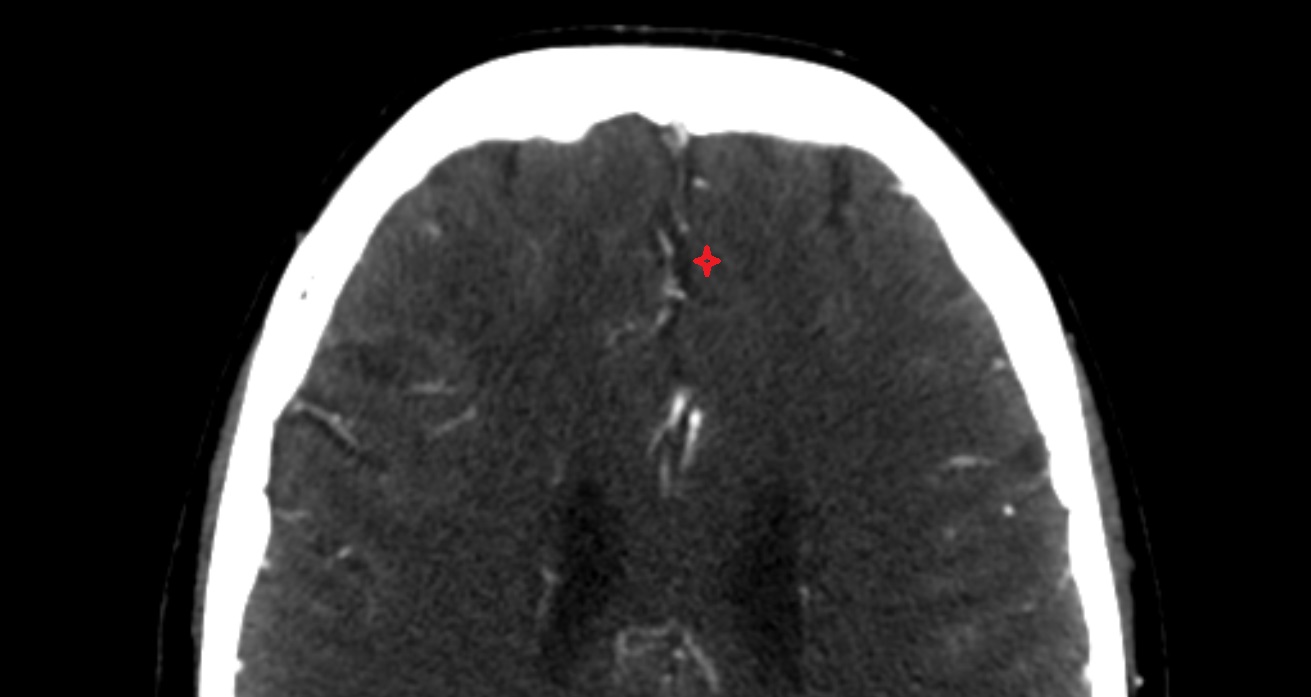 Medial frontal gyrus  CT axial anatomy image -img-00001-00001