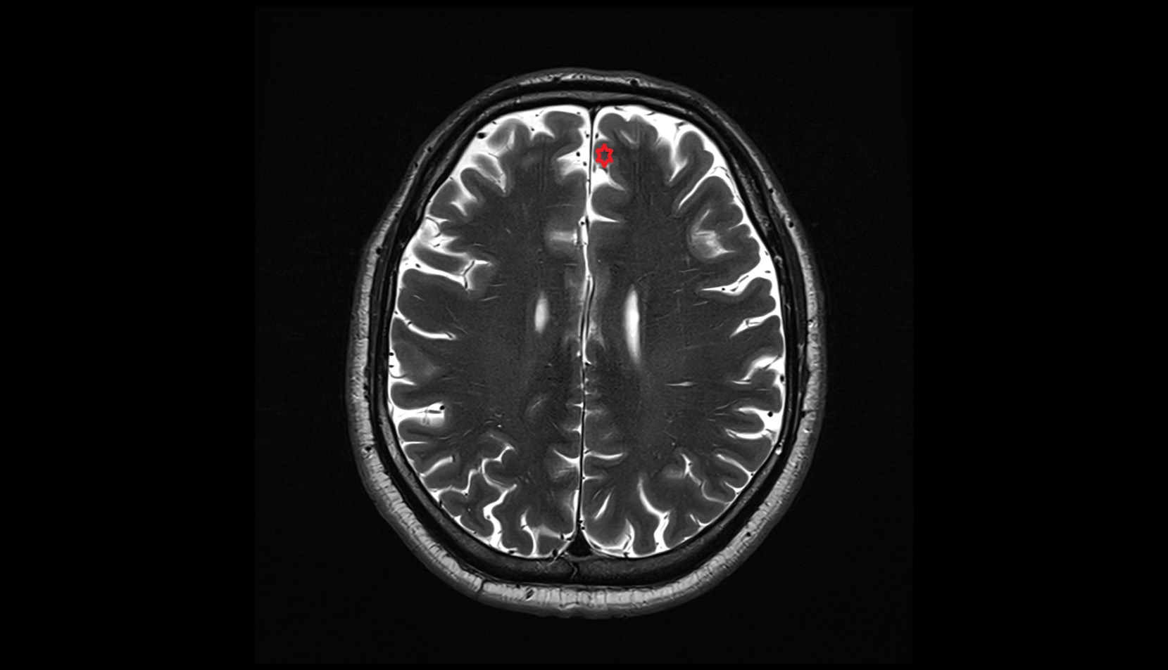 Medial frontal gyrus mri 3t axial image