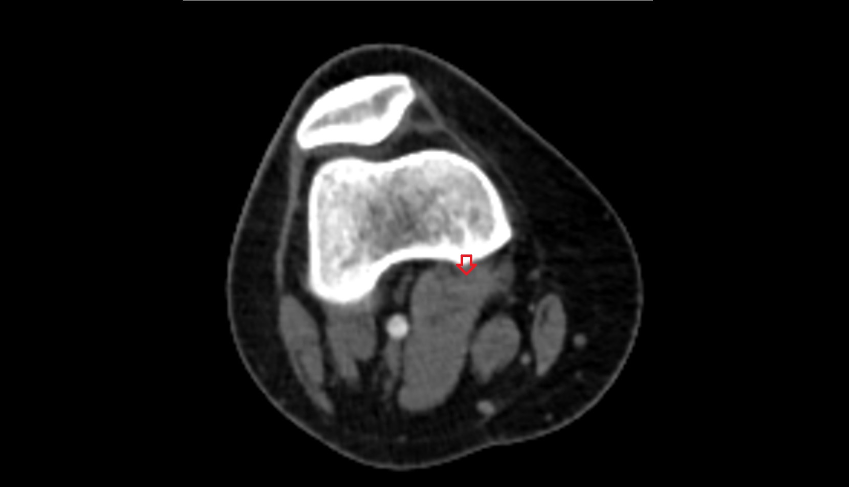 Medial gastrocnemius tendon ct axial image